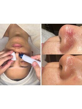 毛穴ケアをしたい