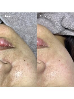 ホワイトワックス 浜松(WHITE WAX)/究極のクレンジングでくすみ飛ぶ