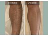 【男性限定】短パンはこう！あし脱毛セット（腿、ひざ、すね、脚の甲と指｝