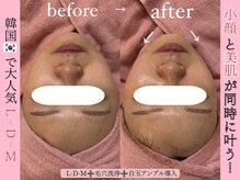 エンクリニカルラボ 京都駅前店(E&N CLINICAL LABO)/美肌小顔W照射/L-D-Mパッケージ