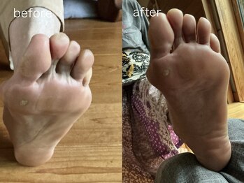 文京指圧/施術before/after