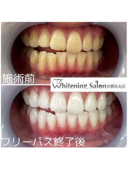ホワイトニングサロン 京都烏丸店/ホワイトニング施術例