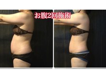 ジャスミン(Jasmine)/たった2回でこのスッキリ感！