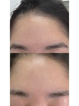 キュル(Kyul)/REVIハーブピーリング