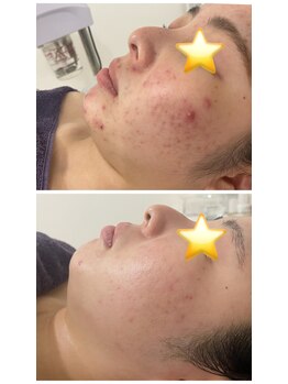 アリュール 京都烏丸御池店(ALLURE)/ハーブピーリング　#ニキビケア