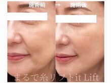 ウルリア(URURIA)/リフトアップ ビフォーアフター