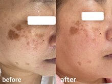 シミケア専門店 SAKURA 平塚店/平塚シミケア/伊勢店シミケア