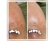 ココスタイルビューティー(COCOSTYLE beauty)の雰囲気（ララピール &nbsp;三回の施術です）