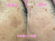 アロマアンドビューティー クリスタルローズ(CRYSTAL ROSE)の雰囲気（◆シミ改善◆リセラのレチノールとハーブピーリングで改善♪）