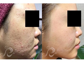 エルビービュティーサロン(LB BEAUTY SALON)/【ニキビ改善】ハーブピーリング