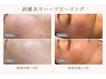 パールプラス 伊勢店(Pearl plus)/攻めの肌ケア♪韓国発