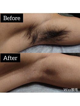 ジュゴン(Dugong)/脇脱毛（Before＆After）