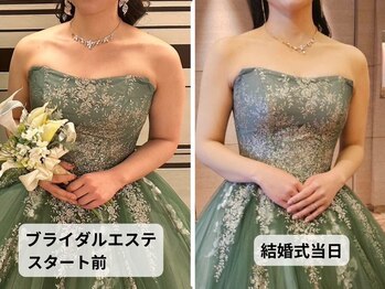 優子さんの美容矯正サロン/練馬のブライダルエステ/ハミ肉