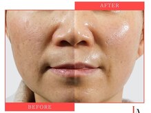 ビューティーリバース 新横浜店/ララピール光フェイシャル60分