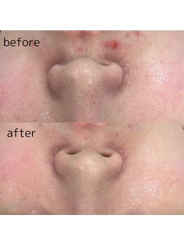 ヴィーナス(Venus)/エステ版ポテンツァ　5回