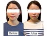 【圧倒的小顔人気No.1】骨格美人へ 美容鍼×小顔矯正スペシャル★60分