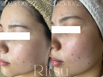 リツ(Ritsu)/ニキビケア/敏感