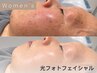 【新規】女性/フェイシャル｜IPL光フォト＋毛穴洗浄エイジングケア 60分