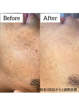 ジュゴン(Dugong)/ヒゲ脱毛（Before＆After）