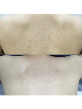 ラナン シエル(Renon Ciel)/背中ケアコース