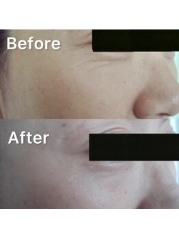 サーティースリー 横浜元町(Thirty3)/IPLフェイシャル Before/After