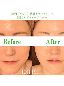 エスプリ 銀座店/ハーブピーリング銀座