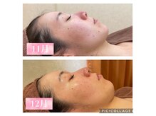 エステテックサロンラレーヌ 小山店(La Reine)の雰囲気（肌荒れ改善もお任せください！しっかりサポート致します☆）