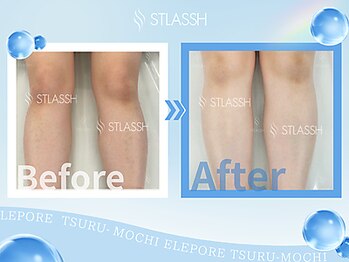 ストラッシュ 刈谷店(STLASSH)/施術例：ひざ下