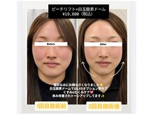クレール 小山店(CLAIR)/【小顔】ピーチリフト