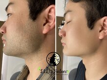 リリーサロン 松本平田店(LILYSalon)の雰囲気（完全予約制のメンズ専門サロンです◎初めての脱毛も安心）