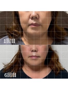 ルアナ(Luana)/6回目の変化 小顔ヘッドスパ