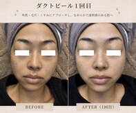 毛穴・肌質改善専門 private salon har’e【ハレ】　ピーリング/小顔