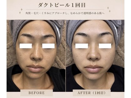 毛穴・肌質改善専門 private salon har’e【ハレ】　ピーリング/小顔の写真