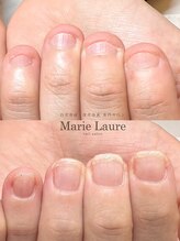 マリーロール 梅田店(Marie Laure)/自爪育成/深爪矯正/ネイルケア