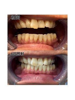 アデル 久留米(ADEL)/ホワイトニング(歯医者提携)