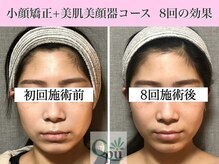 キュープ 福岡九大学研都市店(Qpu)/美顔器モニターコース８回の変化