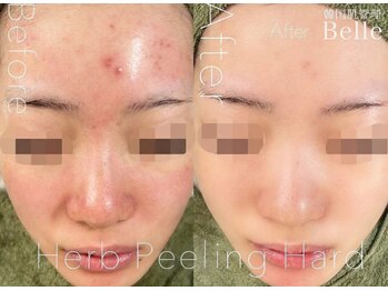 ベル 代々木店(Belle)/ニキビケア施術例