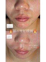 シュシュ(chouchou)/ニキビ悩み、お任せ下さい♪