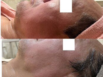 エステサロン ジョアアンジェ(joie ange)/レッドショット3回