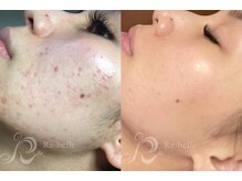 エルビービュティーサロン(LB BEAUTY SALON)/【ニキビ改善】ハーブピーリング