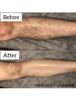 ジュゴン(Dugong)/足脱毛（Before＆After）