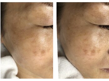 ケトリーナ/光フォト《シミ》