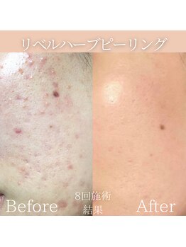 リフィール(Re:feel)/何歳からでも肌質改善できます