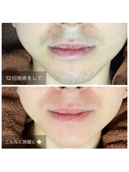 カーロ(CARO)/ひげ脱毛