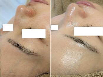 アン(anne)/剥離なしハーバルメソッド×8回