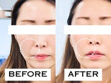 ビハリスト 麻布十番/ほうれい線が改善！