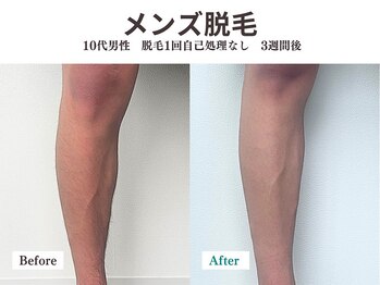 プレデト 天神店(PreDeto)/脱毛Before/After症例