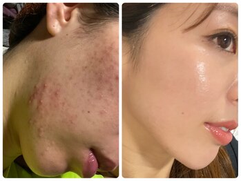 アリュール 京都烏丸御池店(ALLURE)/ハーブピーリング　#ニキビケア