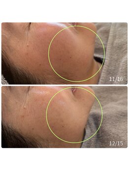 チョチョワンプラス(緒々one+)/フェイスラインの緩みが気になる