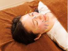 ララ鍼灸サロン(LaLa鍼灸サロン)/【美容鍼】メリハリのあるお顔へ